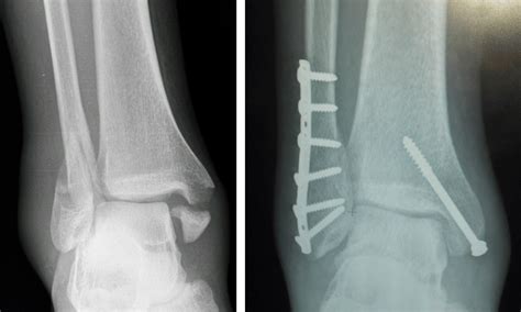 Ankle Fractures - Management - Reduction - TeachMeSurgery