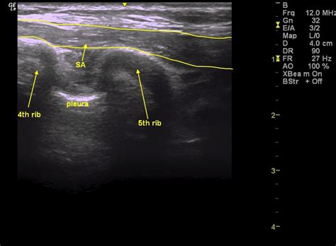 An anatomical evaluation of the serratus anterior plane block - Mayes ...