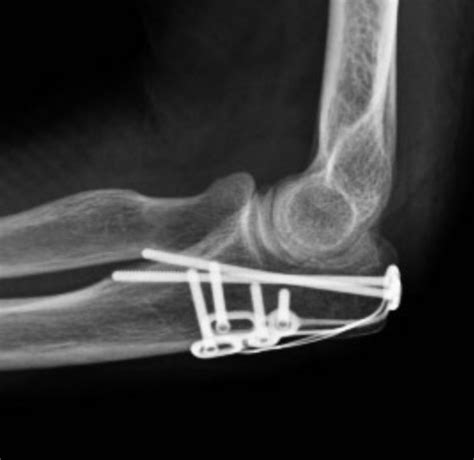 Olecranon Fracture Fixation | Arm Docs