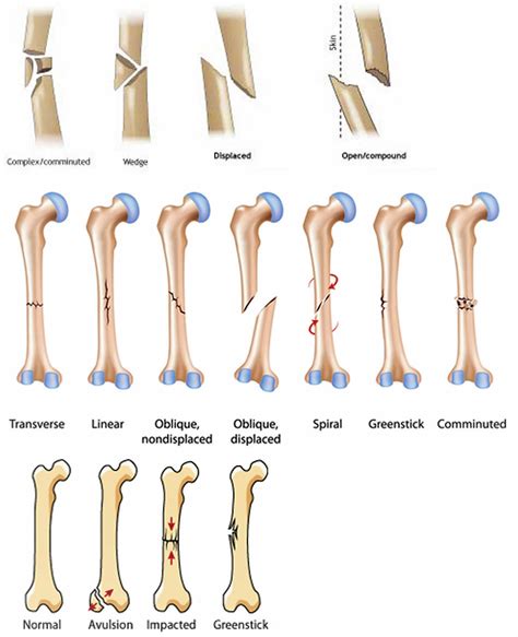 Broken femur types, causes, treatment, recovery time & complications