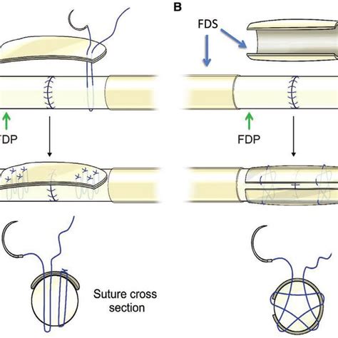 illustrations of novel flexor tendon repair techniques. a, ar involves ...