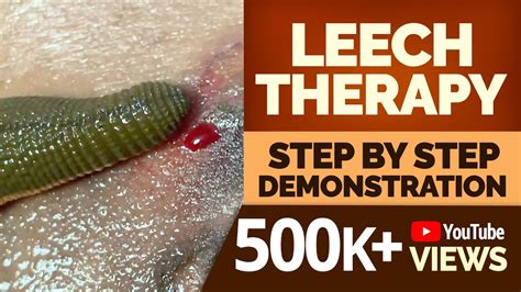 LEECH THERAPY: Step by Step Demonstration - YouTube