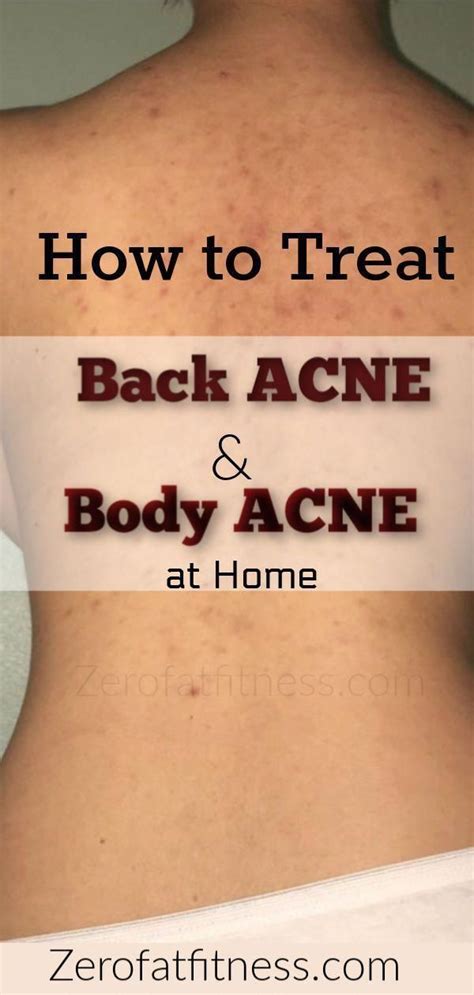 How to Get Rid of Back Acne Overnight at Home - 9 Natural Remedies for ...