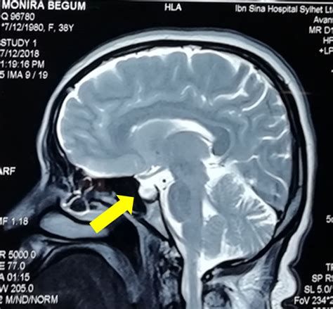 2. Empty sella turcica on MRI brain | Download Scientific Diagram