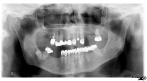 Anatomy Monday: Infraorbital Canal – Dr. G's Toothpix