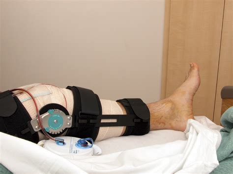 ACL Surgery Recovery Timeline | OSG