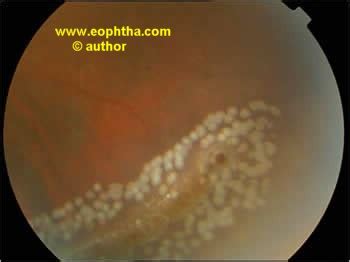 Lattice degeneration of the retina