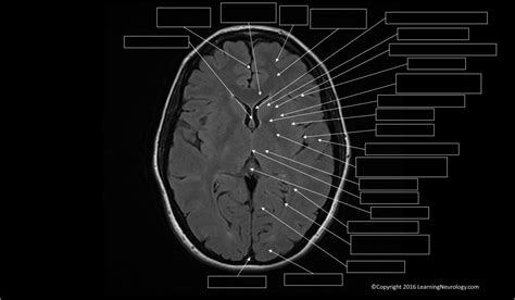 Brain Mri Labeled