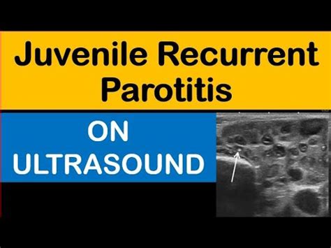 Juvenile Recurrent Parotitis On Ultrasound - YouTube