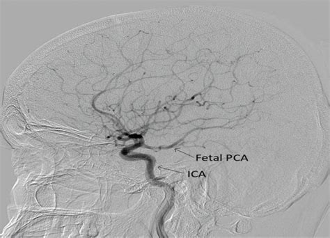 Cerebral angiogram with variant in posterior cerebral circulation ...