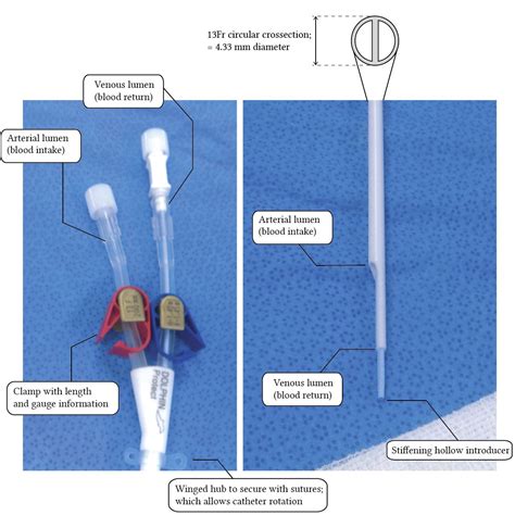 Vascular access for urgent dialysis | Deranged Physiology