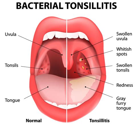 Tonsils and adenoids | Mr George Murty