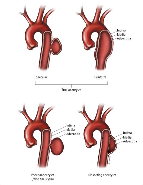 Life Expectancy After Thoracic Aortic Aneurysm Surgery - Good Life ...