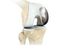 Total Knee Replacement Elmhurst, IL | Unicondylar Knee Replacement ...