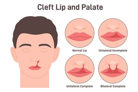 Cleft Palate and Cleft Lip Doctor Philadelphia