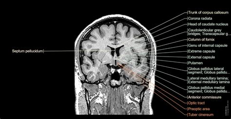 Mri Brain Anatomy