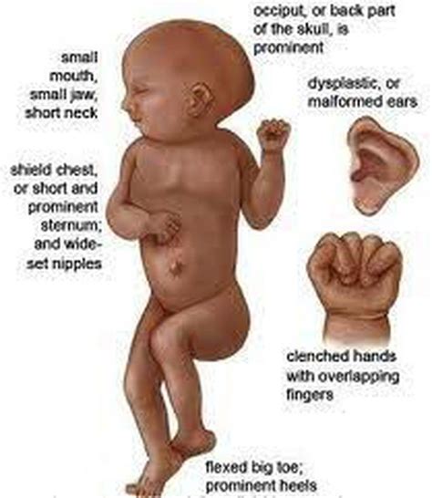 Symptoms of Edwards syndrome - MEDizzy