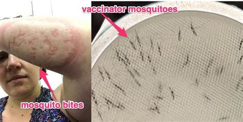 Woman Bitten by More Than 600 Mosquitoes in Malaria Vaccine Trial