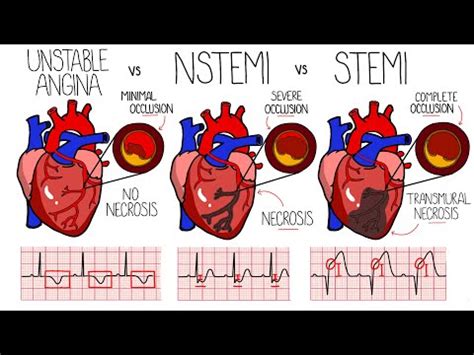 Acute Coronary Syndrome (Heart Attack) - Unstable Angina vs NSTEMI vs ...