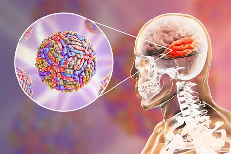 The Symptoms and Causes of Encephalitis: When to Take Precaution