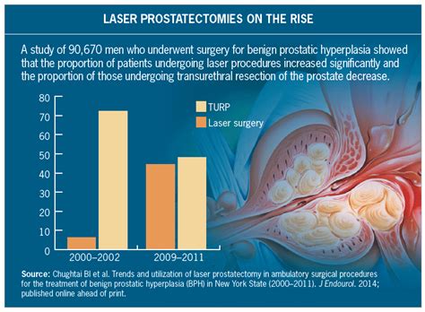 Laser Surgery Gaining on Transurethral Resection (TURP) for Enlarged ...