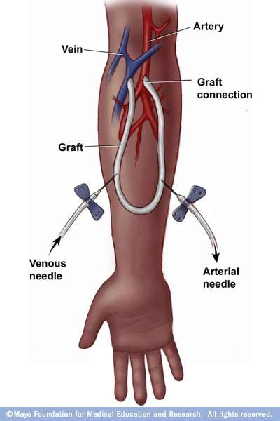 Av Fistula | Auscultate for “whooshing” sound over the fistula.*Palpate ...