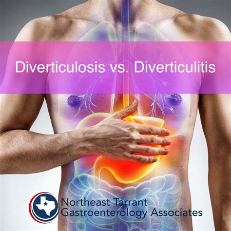 Diverticulosis & Diverticulitis | Bloating | Constipation | North ...