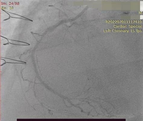 Management of In-stent Restenosis - Indian Journal of Cardiovascular ...