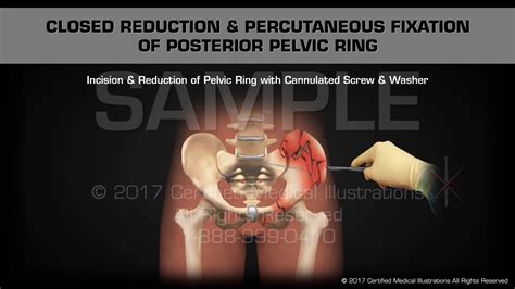 Pelvic External Fixation