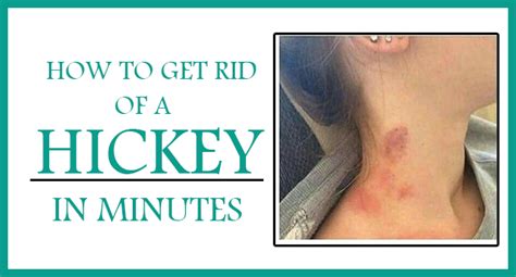 How to Get Rid of Hickey in Minutes - 10 DIY Methods - Remedies Lore