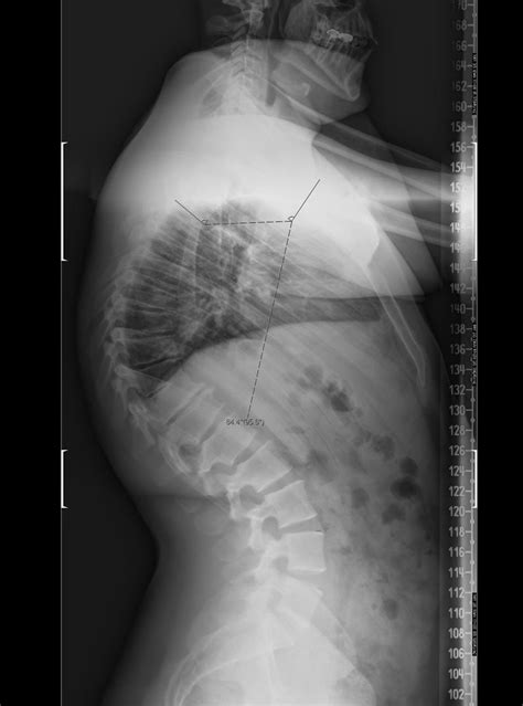 Scheuermann's Kyphosis - Spine - Orthobullets