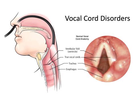 How To Treat Vocal Nodules At Home - Homemade Ftempo