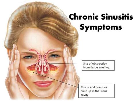 Chronic Sinusitis Symptoms and Treatments - Sggreek.com