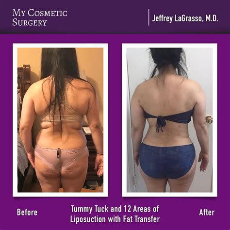 Before and After a Tummy Tuck and Brazilian Butt Lift by Jeffrey ...