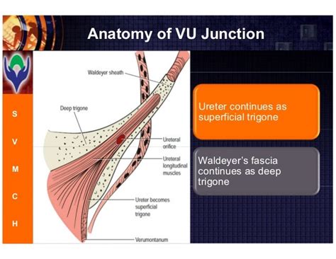 Vesicoureteric Reflux- commonest cause for pediatric UTI