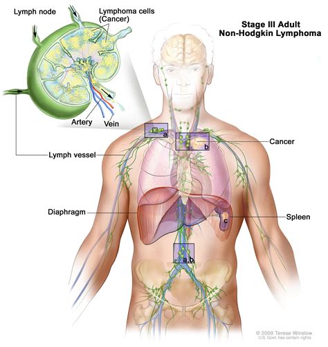 Mantle Cell Lymphoma - Symptoms, Prognosis, Treatment « CancerWORLD ...