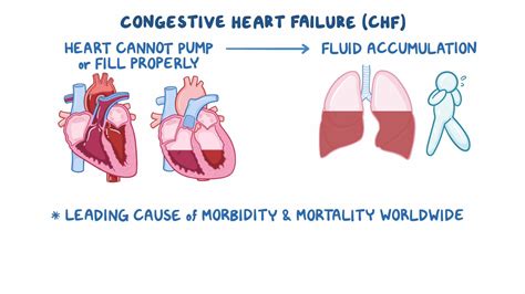 Congestive heart failure: Clinical sciences - Osmosis Video Library