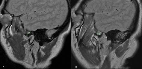 Tmj Axial Mri