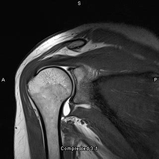 Shoulder Arthrogram MRI | MRI~My Job. | Pinterest