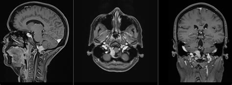 Foramen magnum Meningeom - Ars Neurochirurgica