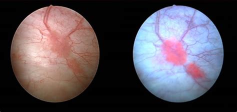 Blue Light Cystoscopy | Bladder Cancer Diagnosis and Treatment ...