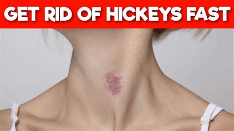 8 Ways to Get Rid of Hickey IN MINUTES - YouTube