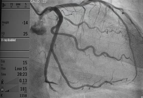 Coronary angiogram Images, Pictures in .jpg HD Free Stock Photos