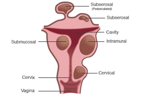 Caring Gynae: What are Subserosal Fibroids?