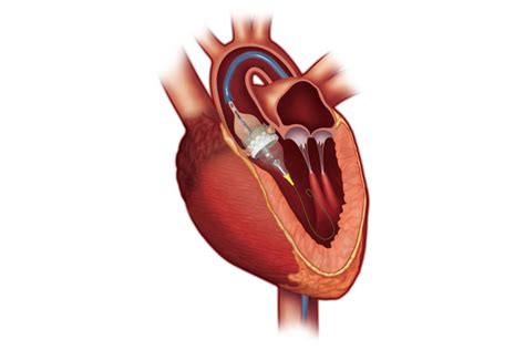 Heart Replacement Valves From Edwards and Medtronic Beat Surgery ...