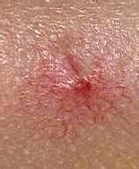 Got HBV? What is Your Skin Trying to Tell You? - Hepatitis B Foundation