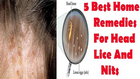 Head Lice Natural Treatment - 5 Best Home Remedies For Head Lice And ...