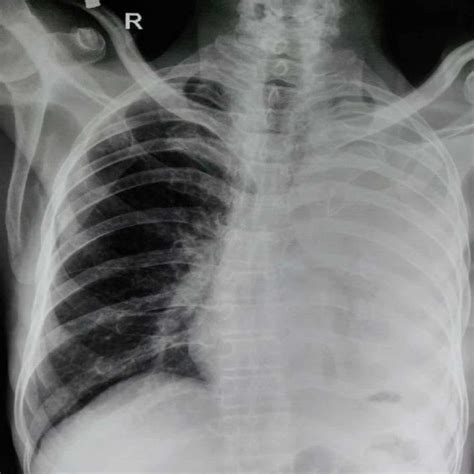 อันดับหนึ่ง 90+ ภาพ Pneumothorax พยาธิสภาพ อัปเดต