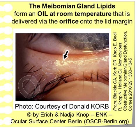 GLIMPSE of ... The MEIBOMIAN GLAND — Ocular Surface Center Berlin