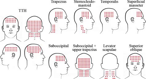 31+ Free Printable Headache Chart Templates [PDF]